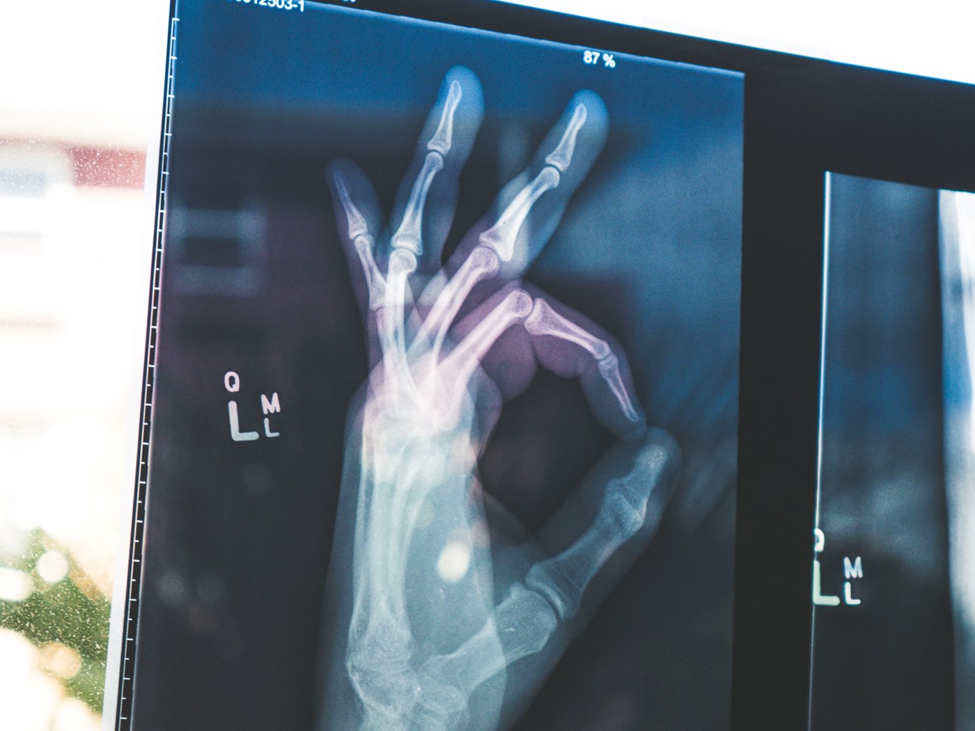Et røntgenbilde av en hånd